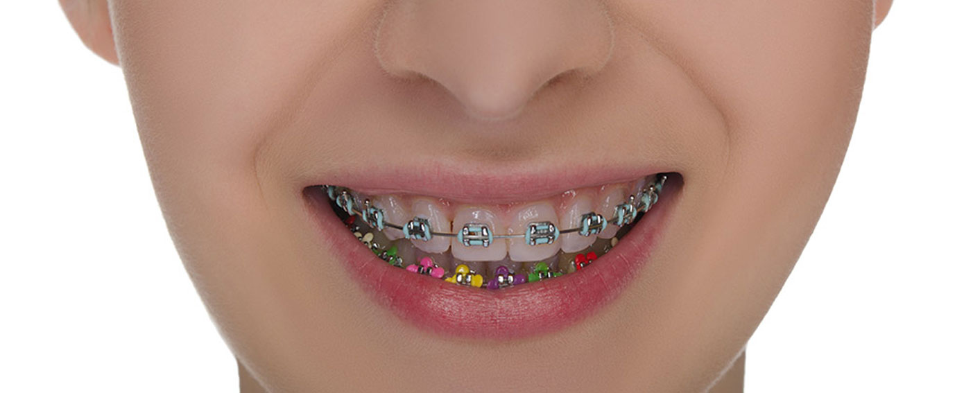 Types of Braces